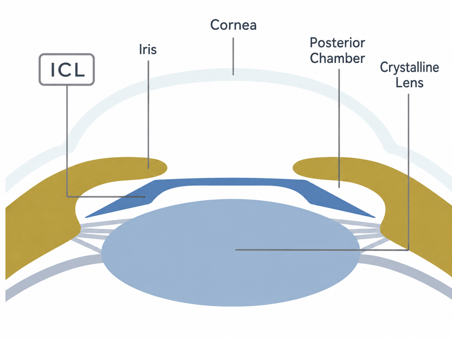 ICL手術とは？のICL挿入断面図解イラスト