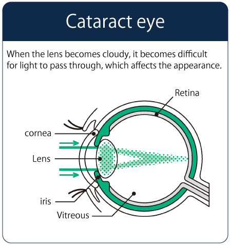 Illustration of cataract eye