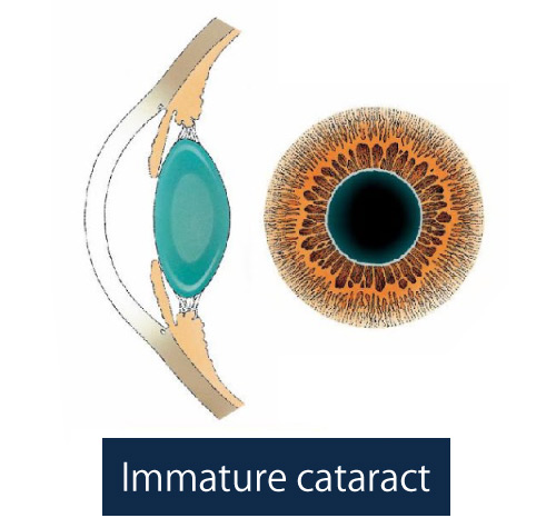 Illustration of immature cataract