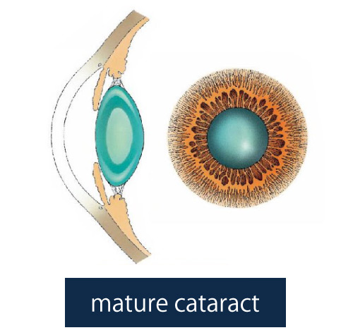 Illustration of mature cataract