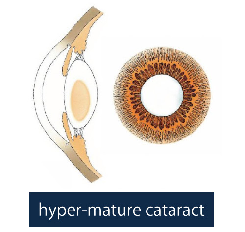Illustration of overripe cataract