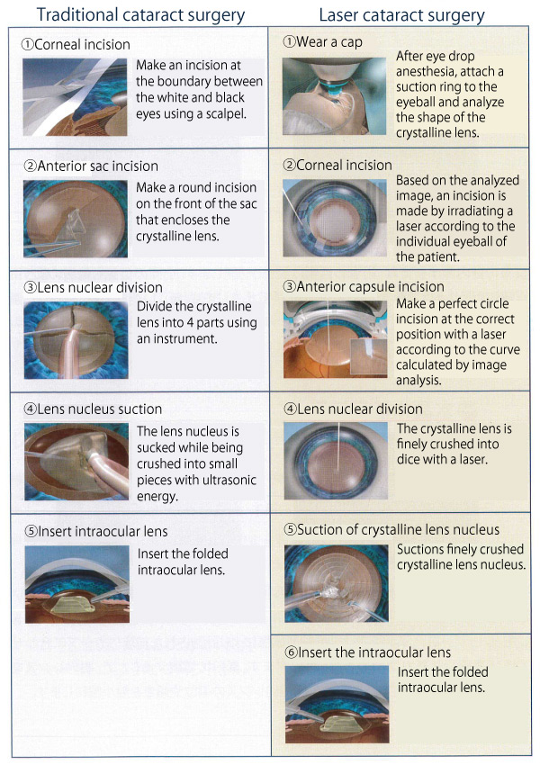 Comparison of traditional cataract surgery and laser cataract surgery