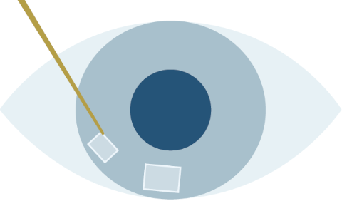 Laser cataract surgery process STEP2 Make an incision