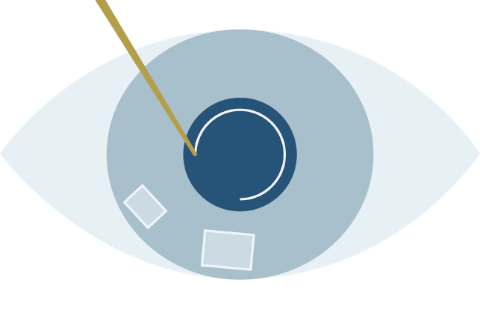 Laser cataract surgery process STEP3 Capsulotomy