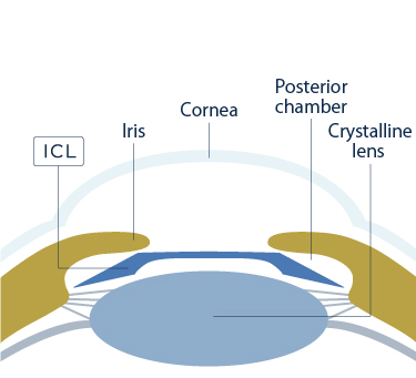 Illustrated about the method of posterior Phakic IOL