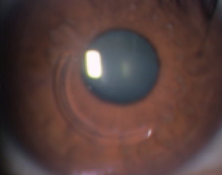 Eyeball after surgery