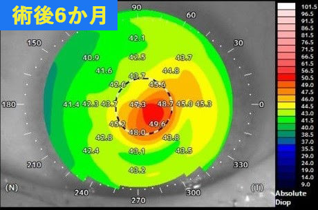 円錐角膜が重度の術後データ