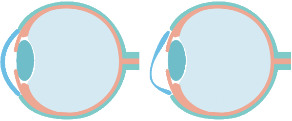 正常な角膜と円錐角膜