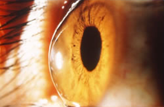 円錐角膜で突出した角膜の画像