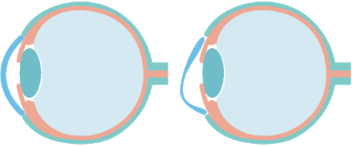 図①　左：正常な角膜　右：円錐角膜