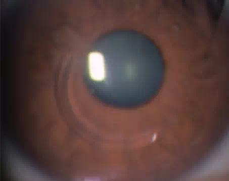 角膜内リングの画像