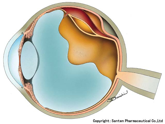 網膜剥離についての画像1