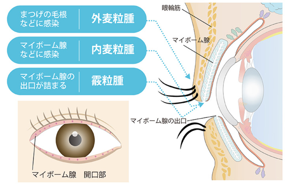 霰粒腫・麦粒腫についての画像