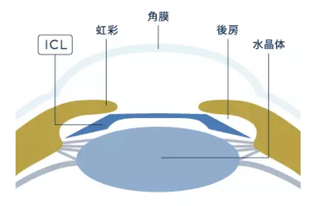 日本テレビZIP！「ICL特集」に院長の北澤世志博医師が取材協力しましたについての画像