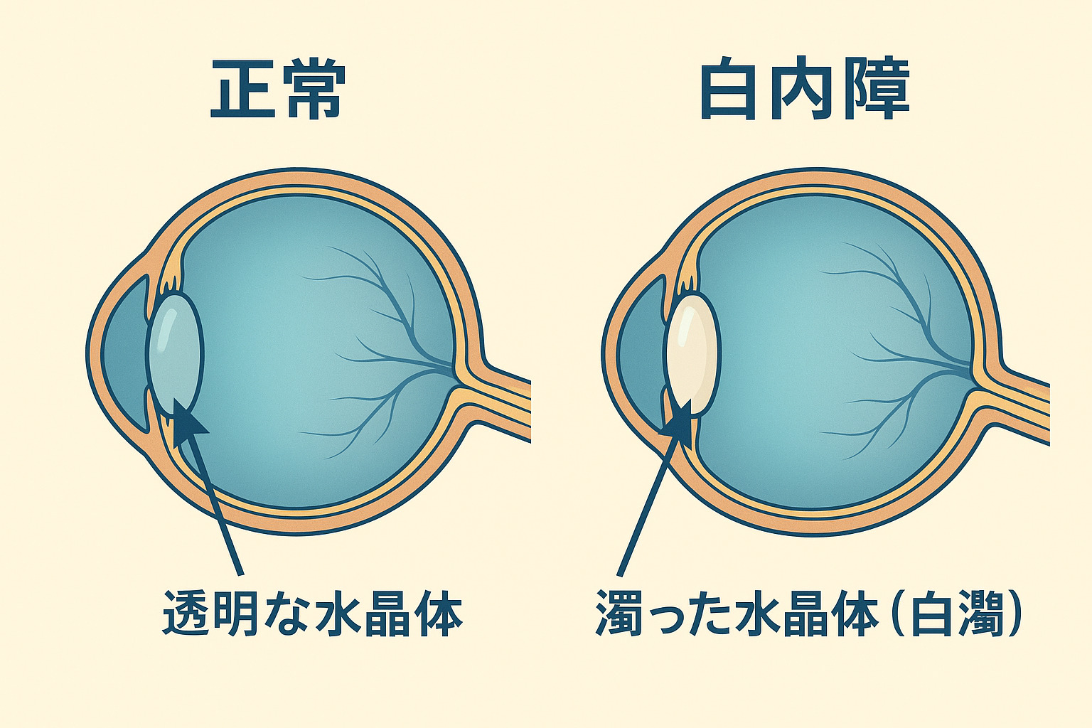 白内障の初期症状:目の違和感から眼科受診まで知っておくべきことについての画像