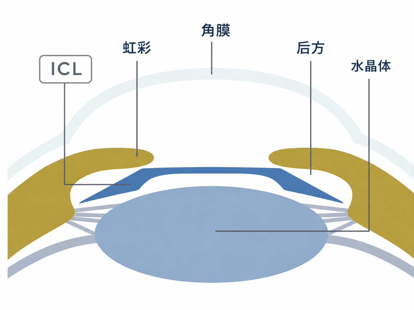 ICL手術とは？のICL挿入断面図解イラスト