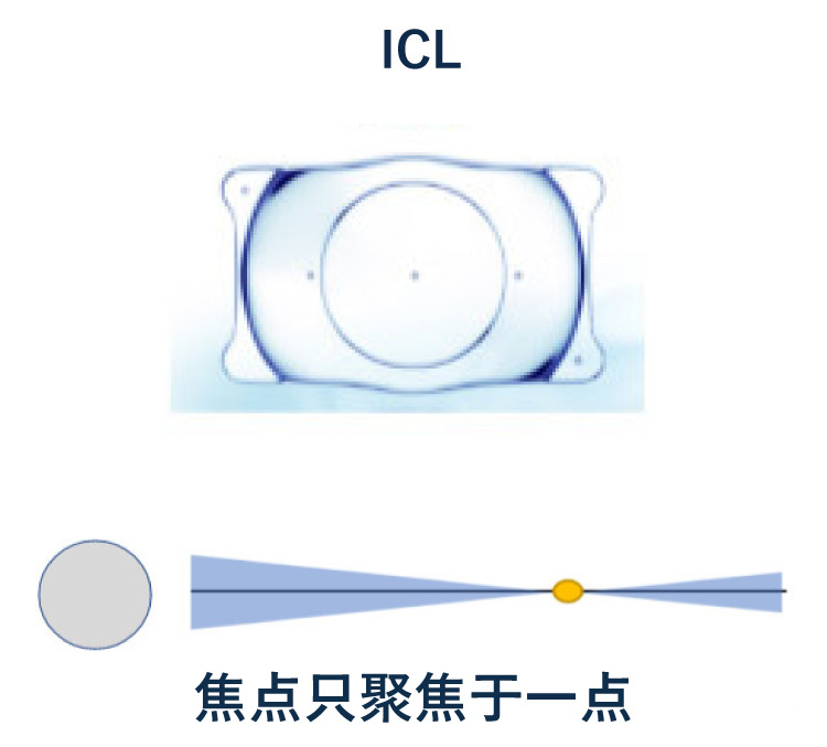 单焦点眼内晶体（ICL）的聚焦方式