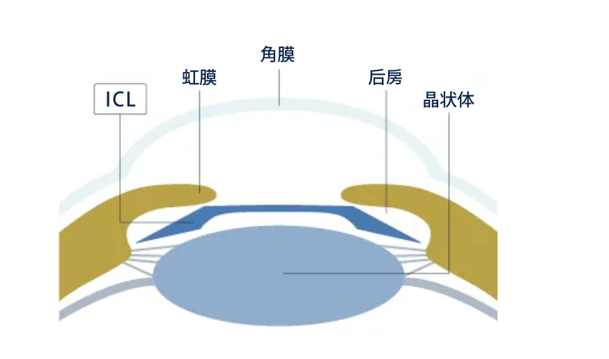 日本テレビZIP！「ICL特集」に院長の北澤世志博医師が取材協力しましたについての画像